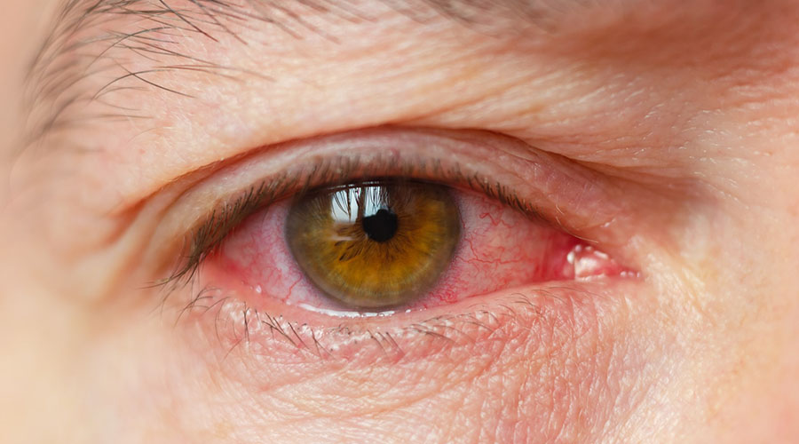 Illustration of Uveitis in the eye